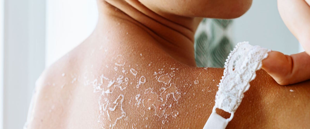 sunburned areas