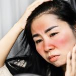relief for sunburn